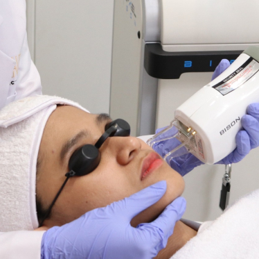 PICO LASER Treatment